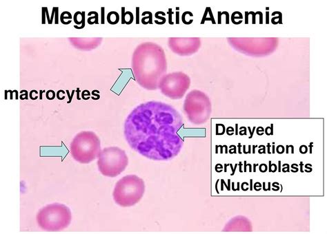 What Cause Megaloblastic Anemia